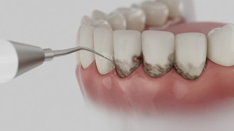 Trusted Wisdom Tooth Removal service in Norristown, PA - Dentist Open Now